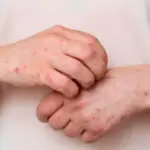 Suman 105 muertes por rickettsiosis en Chihuahua entre 2024 y 2026