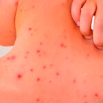 Confirman muerte de menor por rickettsiosis en Chihuahua