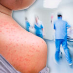 Alertan posible brote de sarampión en California tras exposición de más de 100 menores