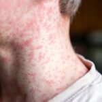 Bebés quedan expuestos al sarampión por baja vacunación en EE.UU.